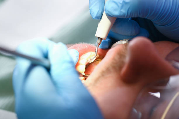 Best Knocked-Out Tooth (Avulsed Tooth) Treatment in Laureles, TX